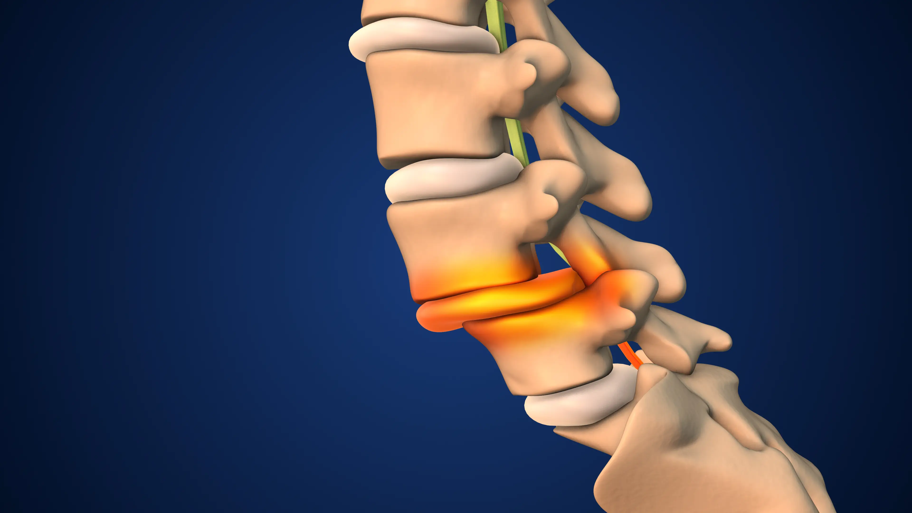What Makes Spondylolisthesis Worse? A Spine Specialist's Complete Guide