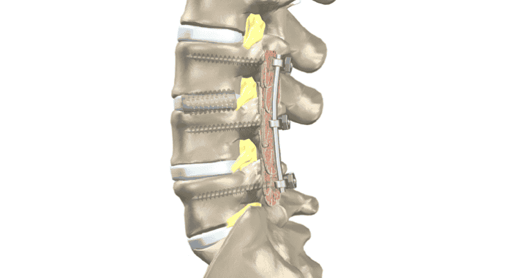 Revision Lumbar Spine Surgery