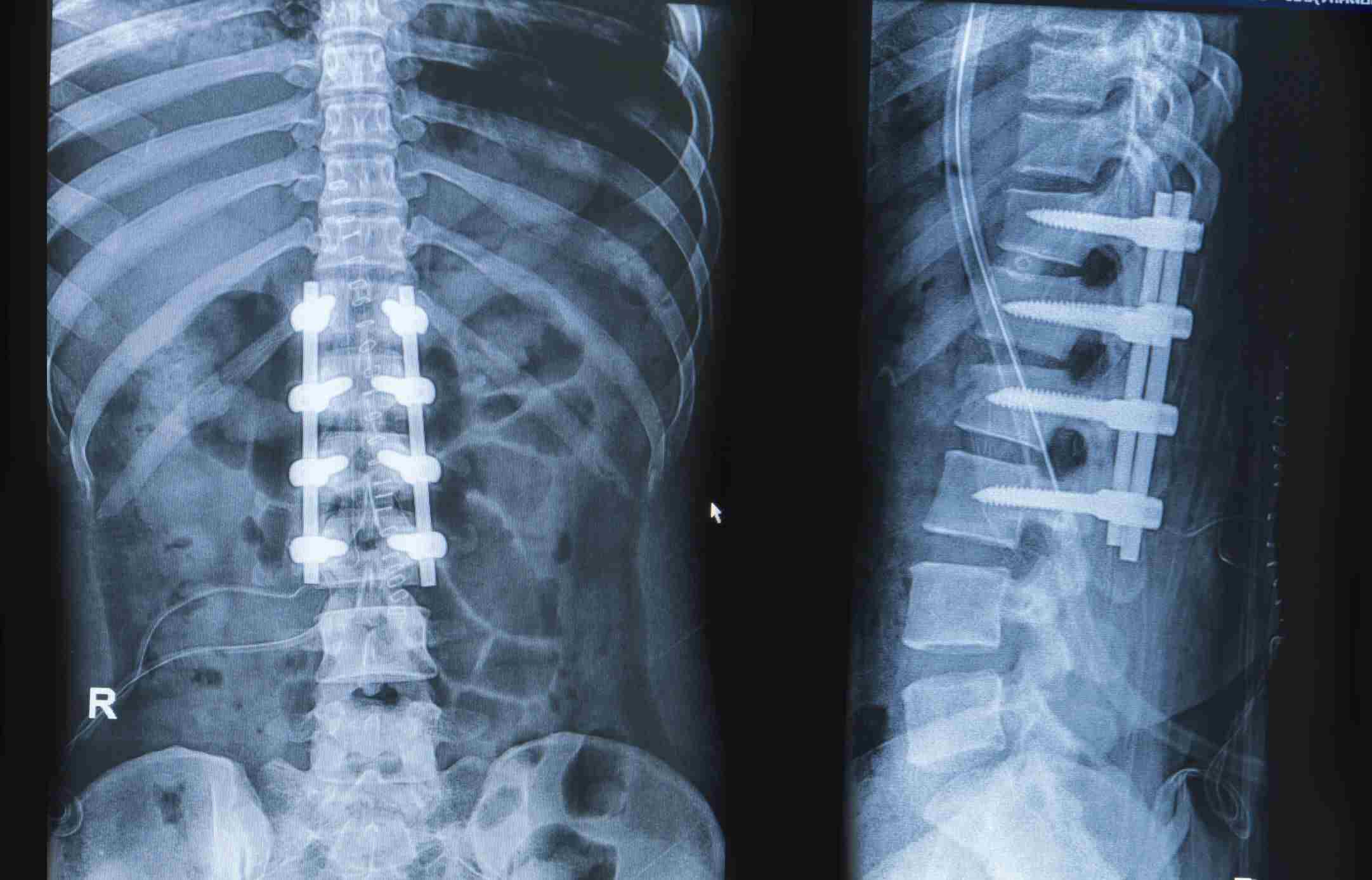 Bone Metastases