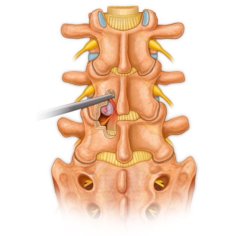 Laminectomy