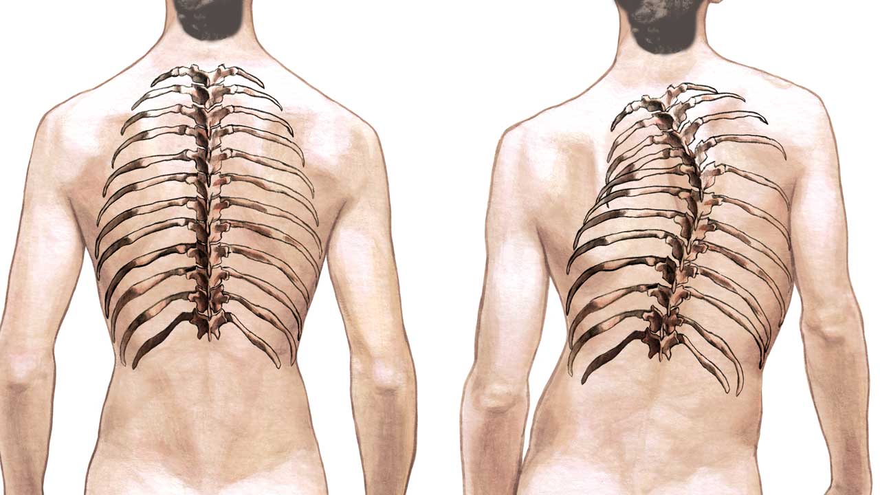 Spinal Deformity Correction