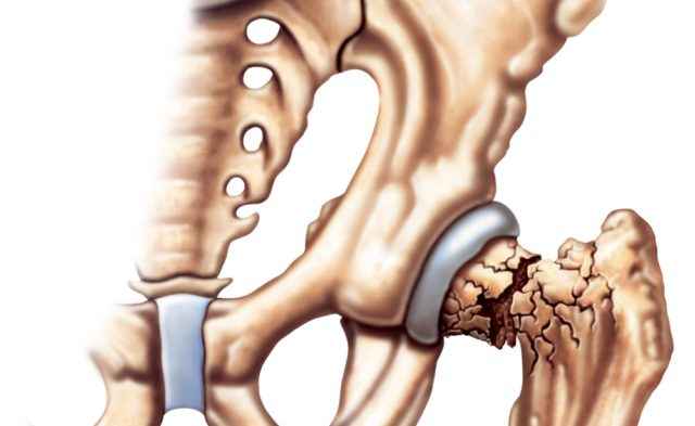 Osteoporotic / Fragility Fractures