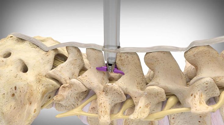 Lumbar Stenosis