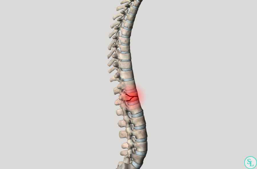 Vertebral Compression Fractures