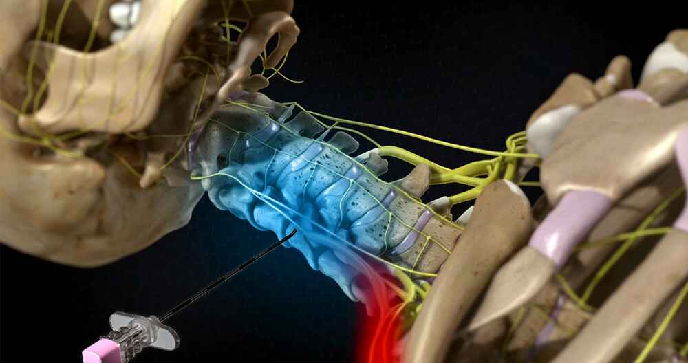 Nerve Root Injection