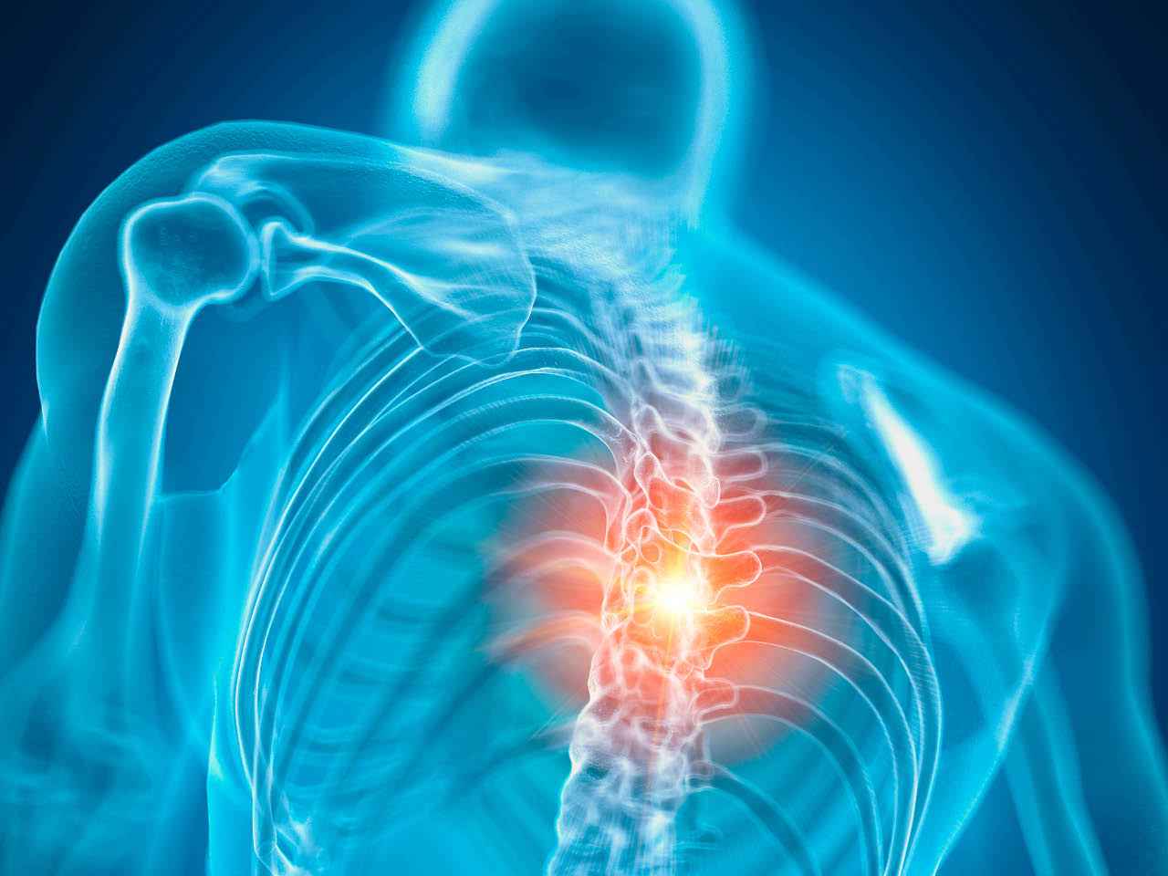 Myelopathy (Spinal Cord Compression)