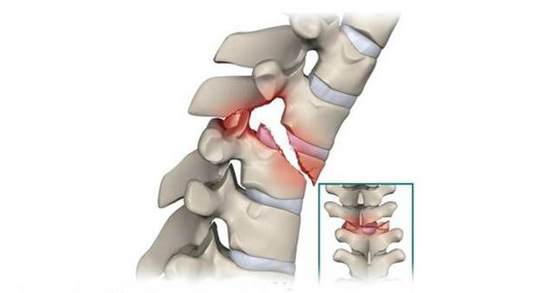 Neck Fracture