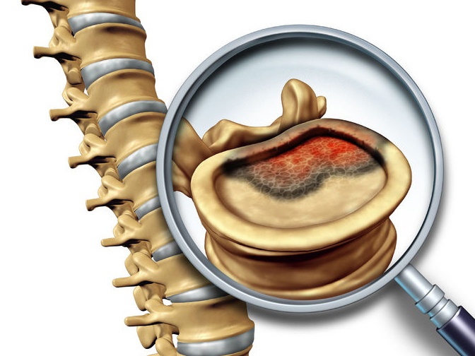 Intradural Spinal Tumours