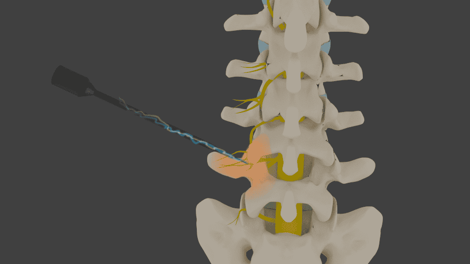 Medial Branch Nerve Blocks