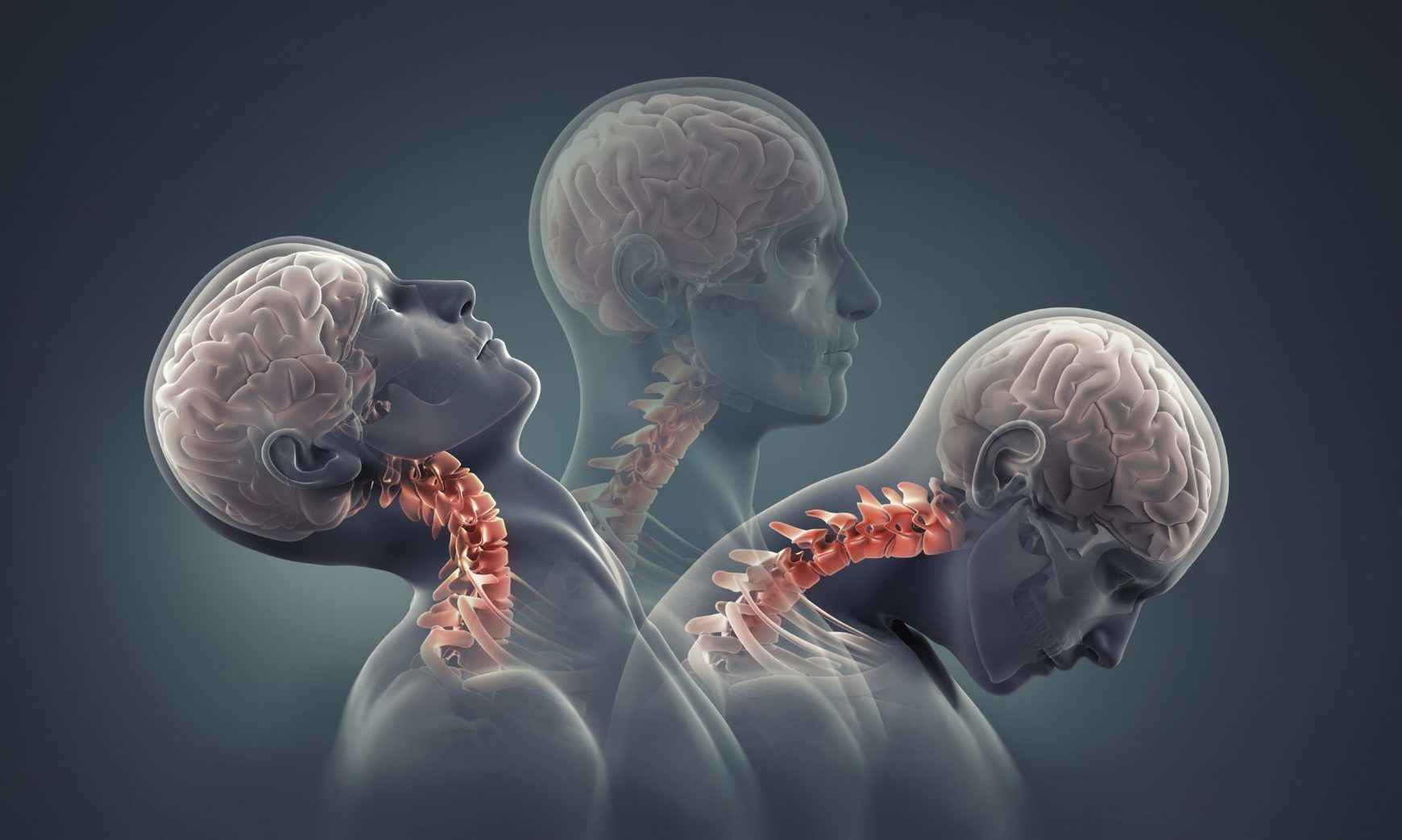 Diagnosis of Cranio-Cervical Instability