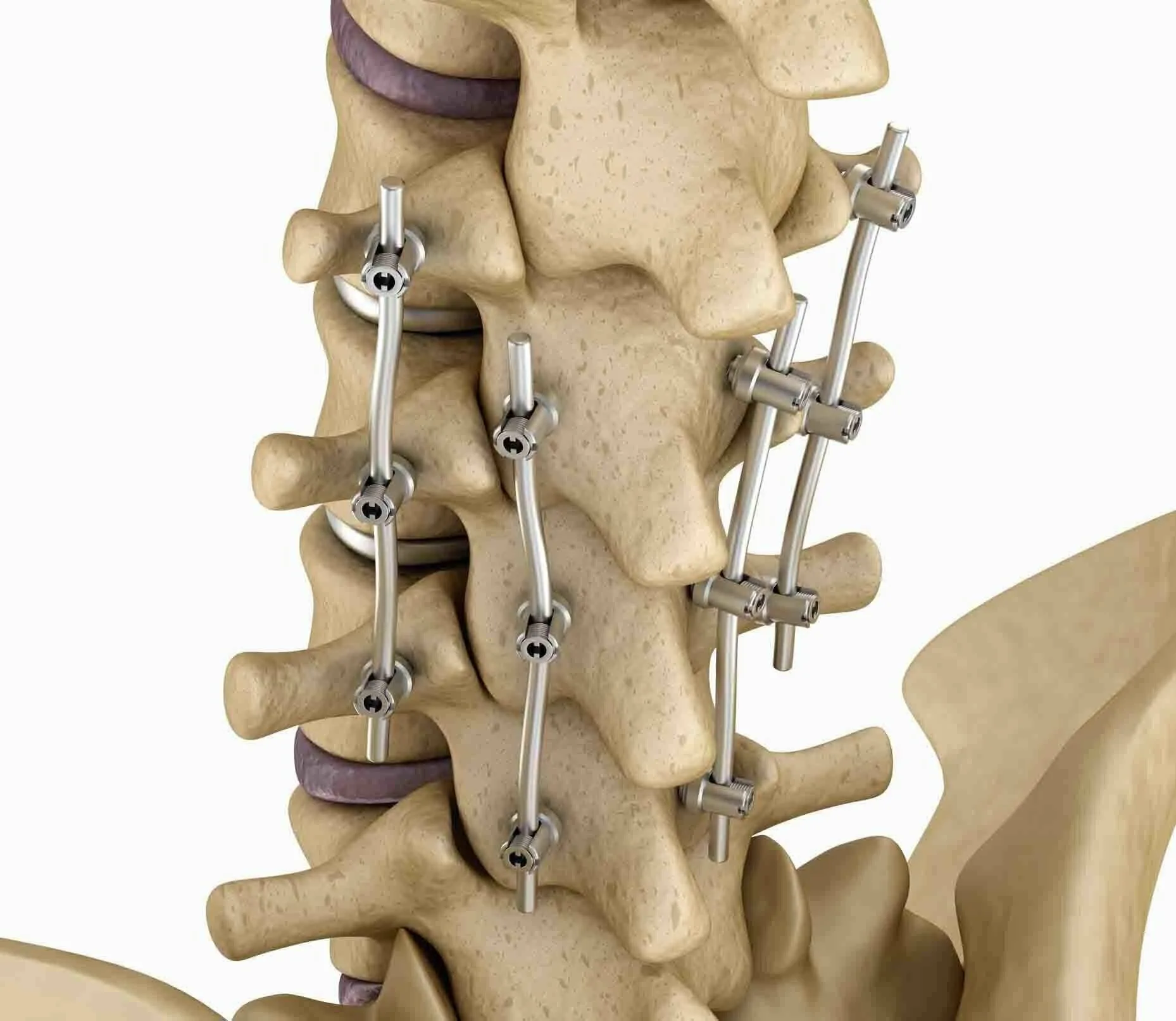 Treatment Options of Revision Lumbar Spine Surgery