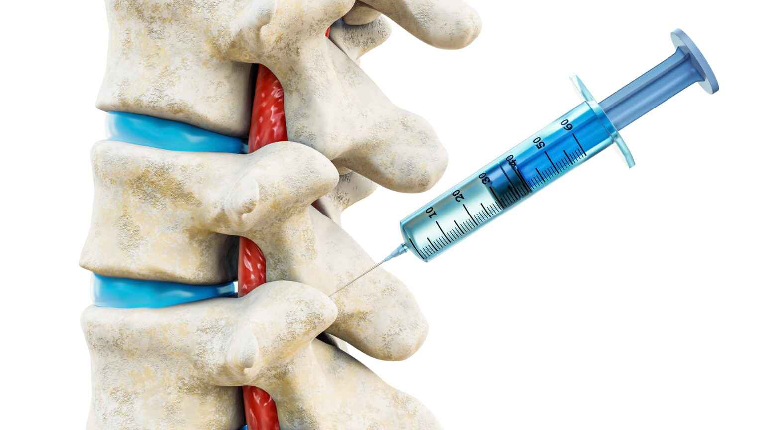 Treatment Options of Steroid Injection