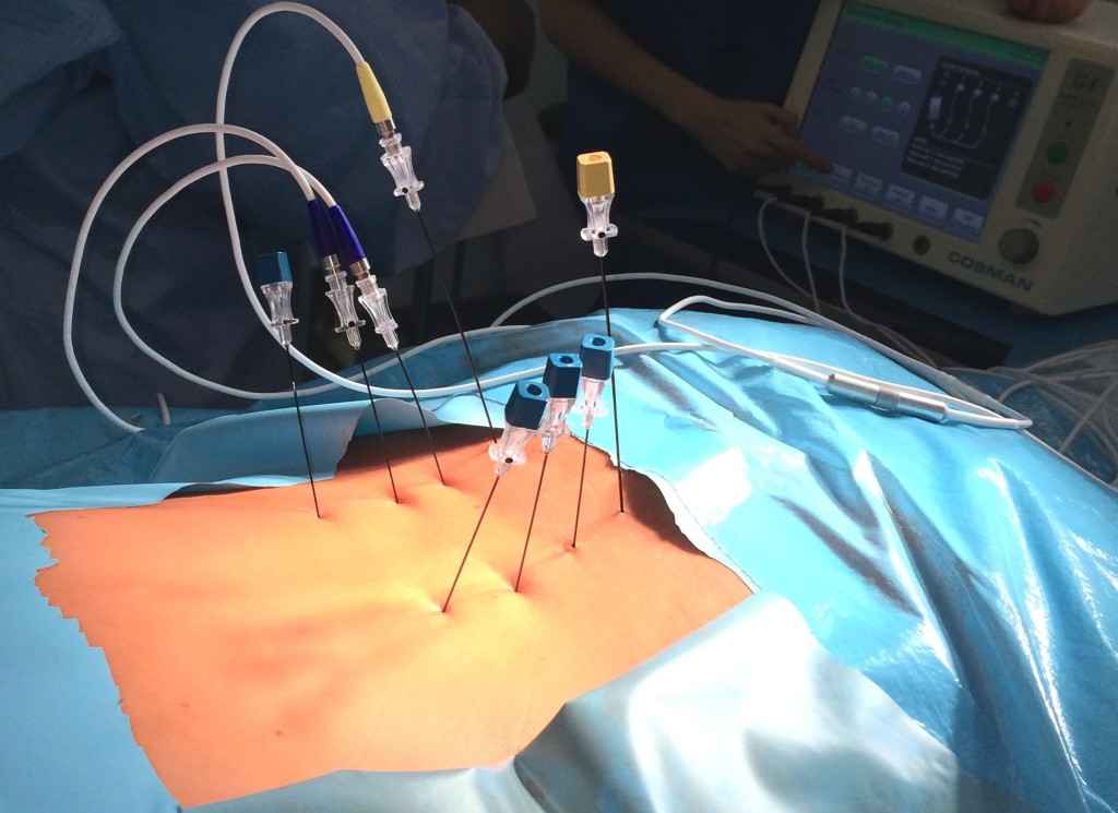 Key Benefits of Endoscopic Spinal Surgery