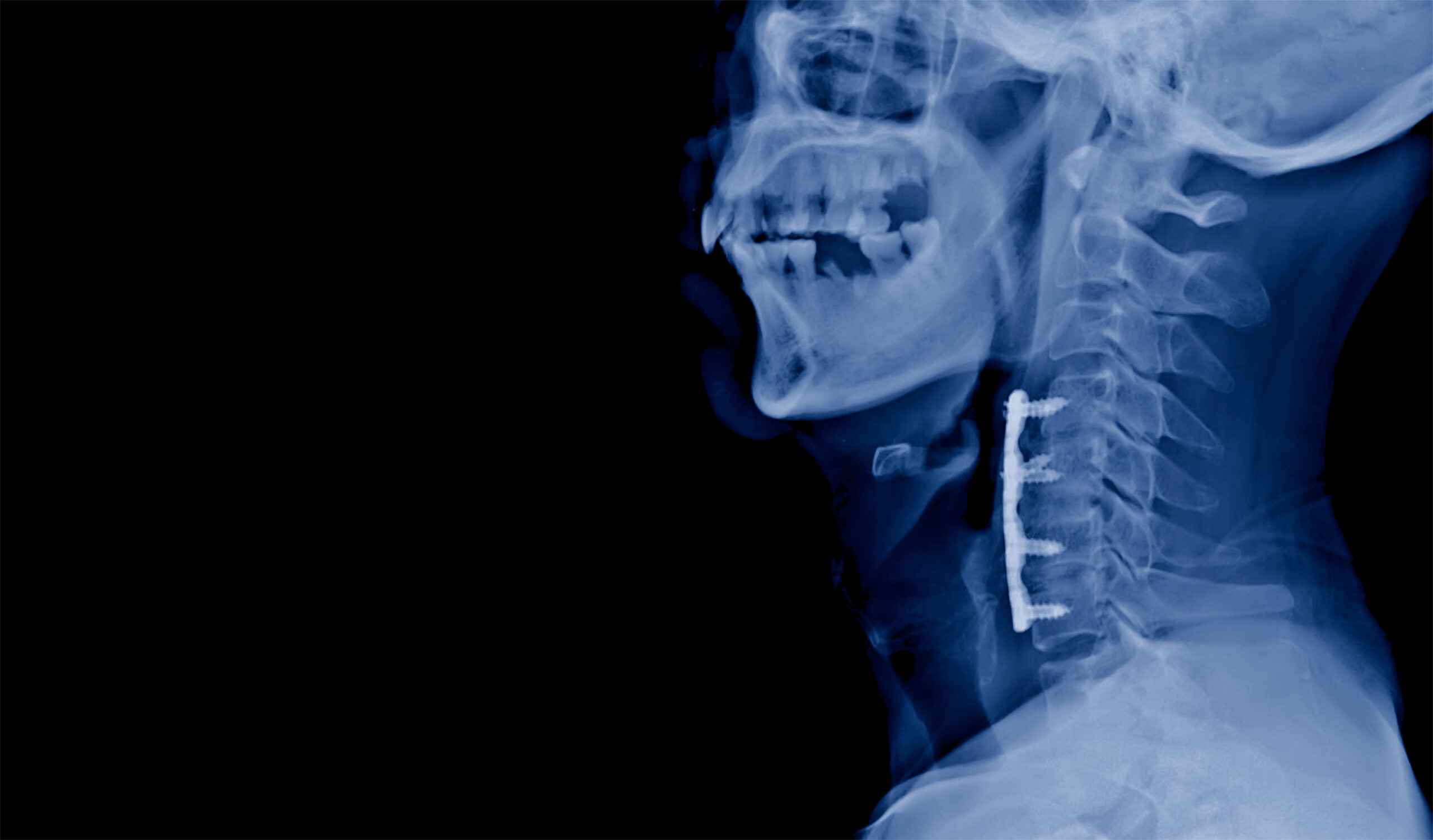 Key Benefits of Anterior Cervical Discectomy Surgery