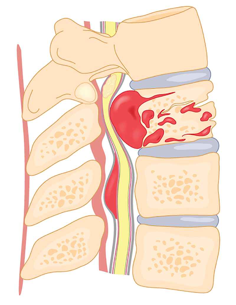 Treatment Options of Intramedullary Spinal Tumors