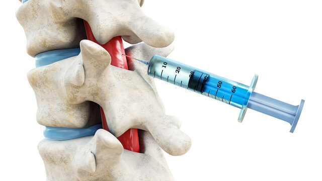 Diagnosis of Spinal Injections for Pain