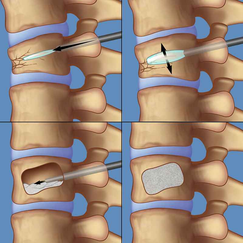 Risks of Balloon Kyphoplasty