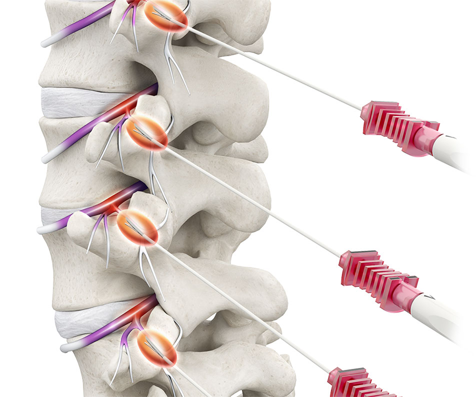 Diagnosis of Medial Branch Nerve Blocks