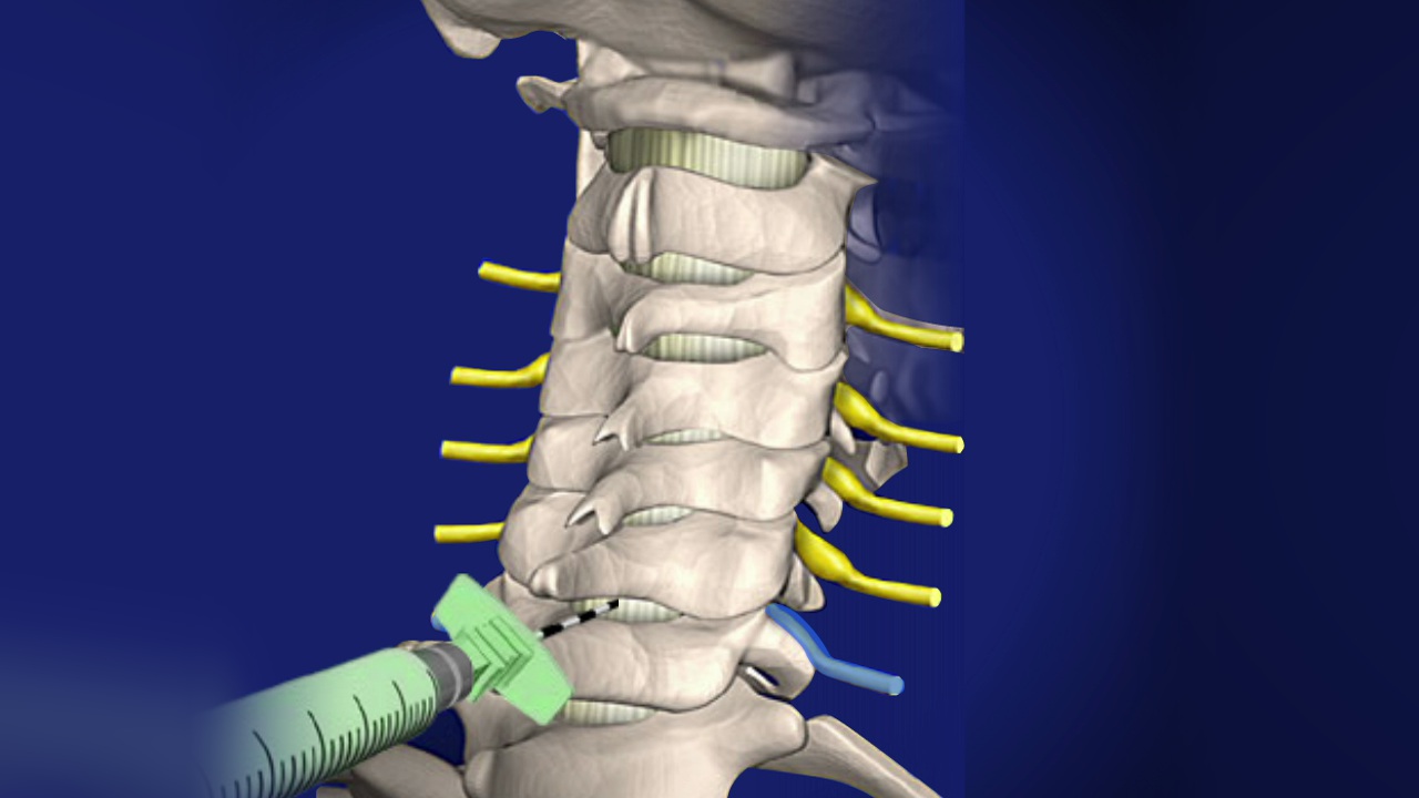 Diagnosis of Nerve Root Injection