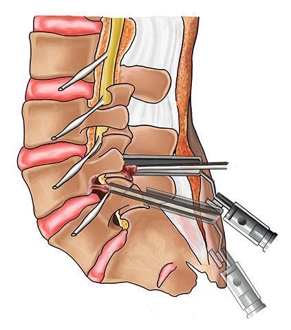 Treatment Options of Laminectomy