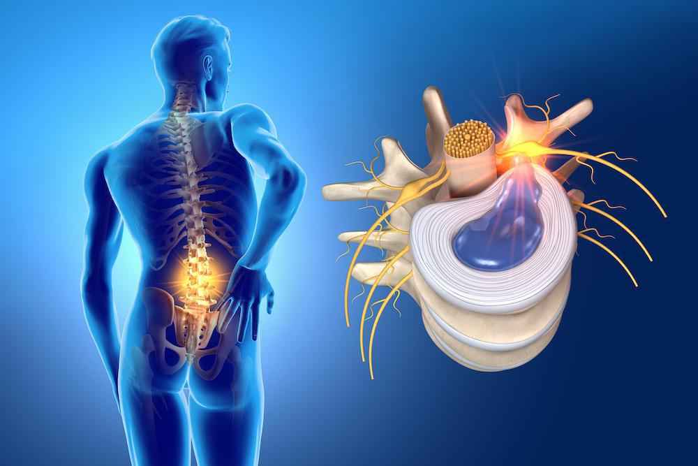 Treatment Options of Lumbar Disc Herniation