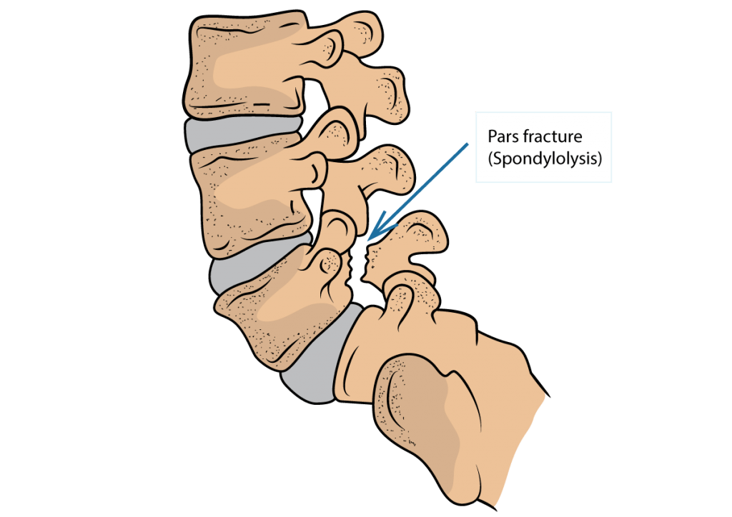 Diagnosis of PARS Fracture