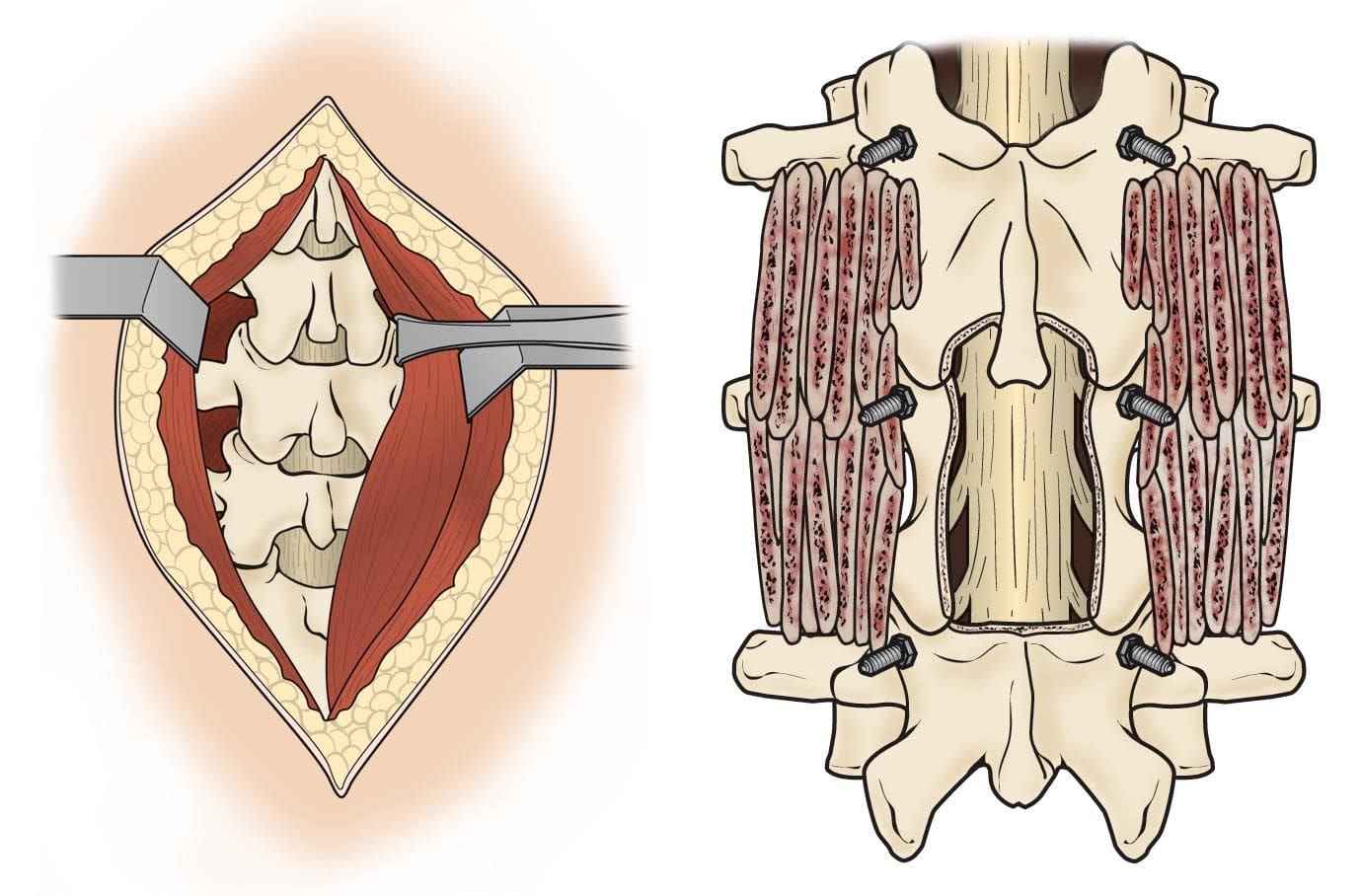 Risks of Open Spinal Surgery