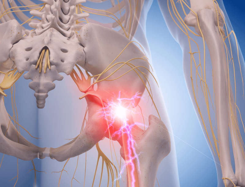 Diagnosis of Sciatica