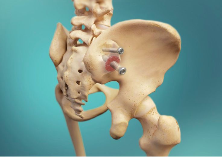 Treatment Options of Sacroiliac Joint Fusion Surgery