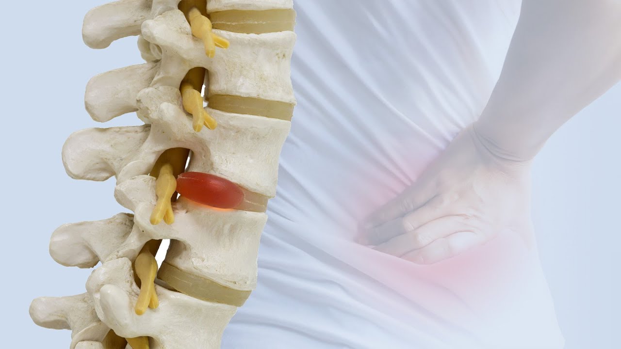 What Is Minimally Invasive Surgery for Spinal Stenosis?
