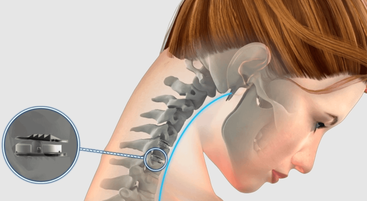 Diagnosis of Cervical Disc