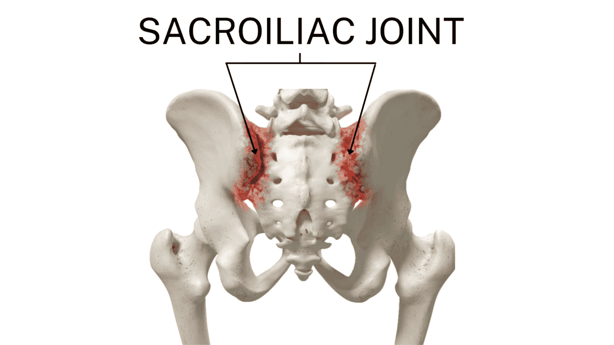 Diagnosis of Sacroiliac Joint Fusion Surgery