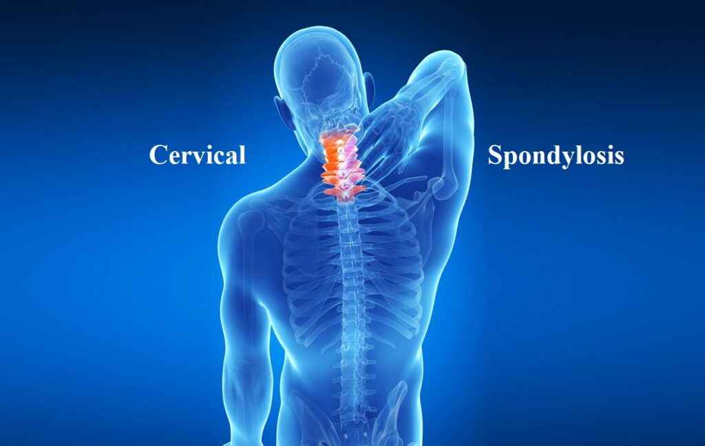 Diagnosis of Spondylitis Spondylosis