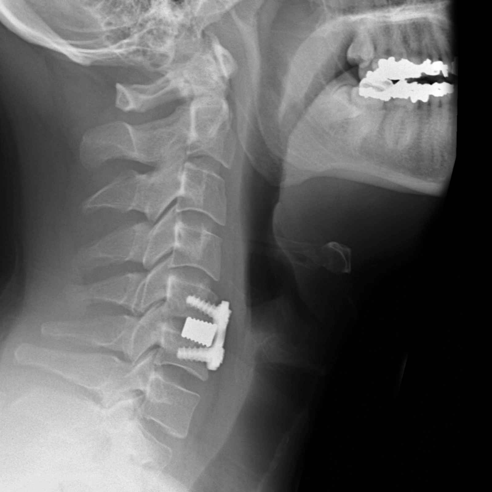 Risks of Anterior Cervical Discectomy Surgery