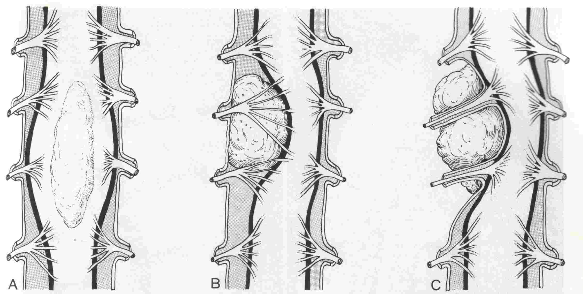 Diagnosis of Intradural Spinal Tumors