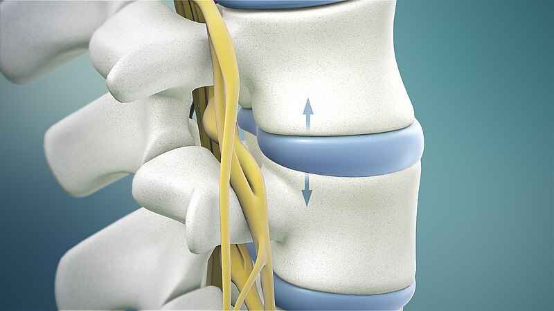 Key Benefits of Lumbar Decompression