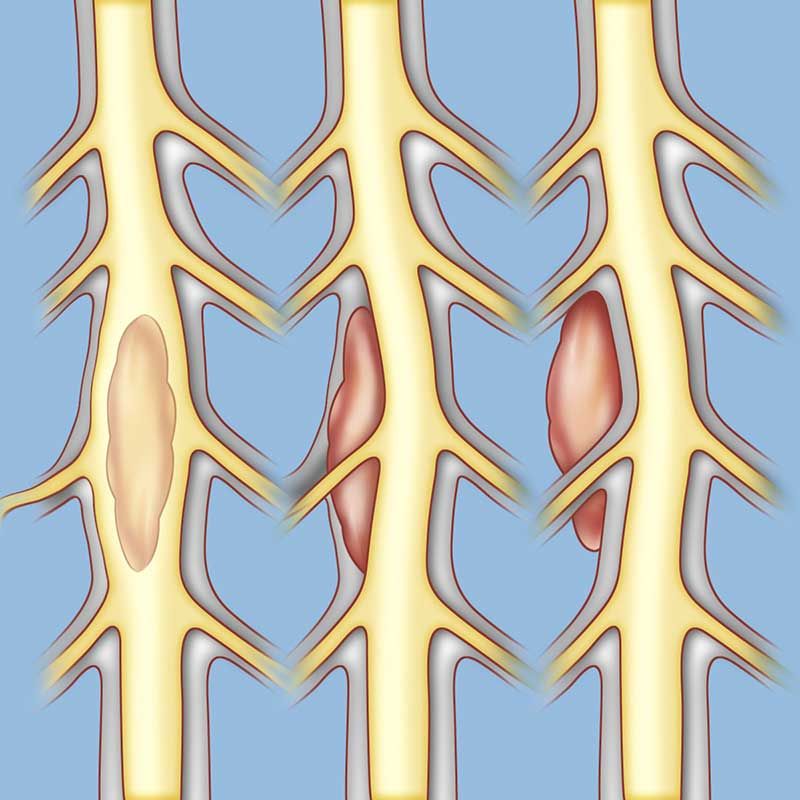 Treatment Options of intradural spinal tumors