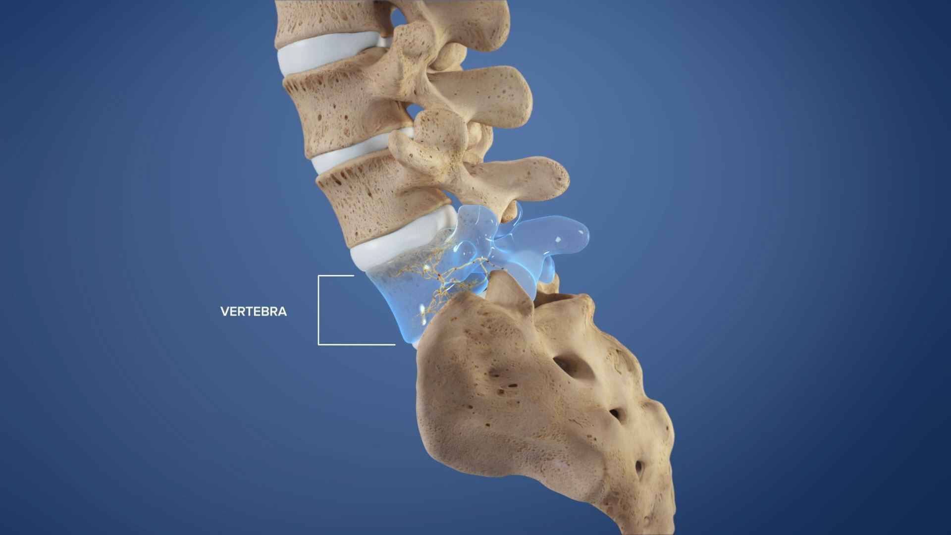 Key Benefits of Basivertebral Nerve Ablation