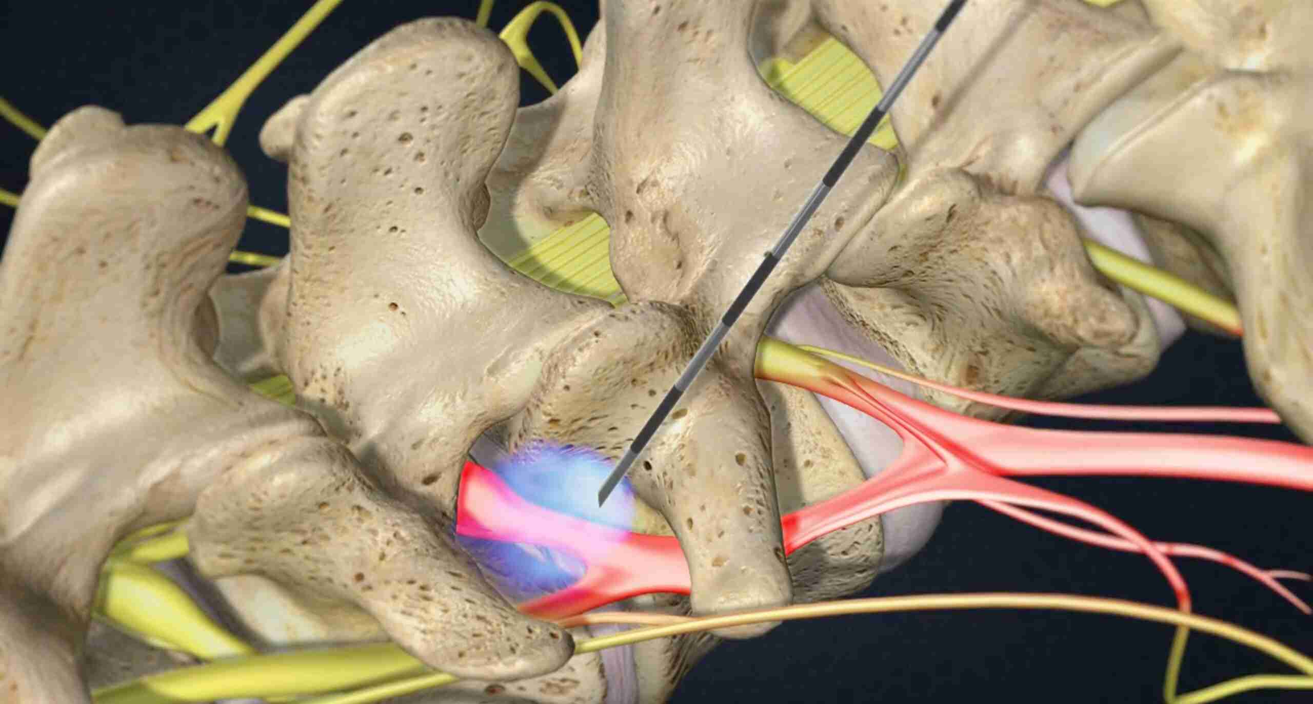 Treatment Options for Nerve Root Injection