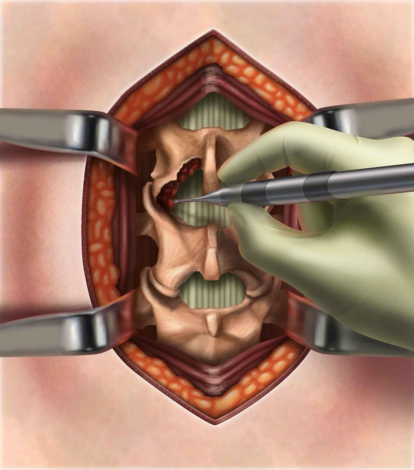 Diagnosis of Laminectomy