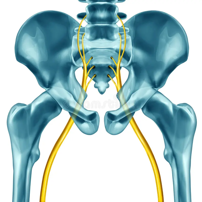 Sciatica Surgery