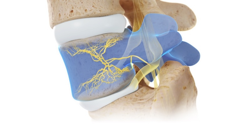 Basivertebral Nerve Ablation