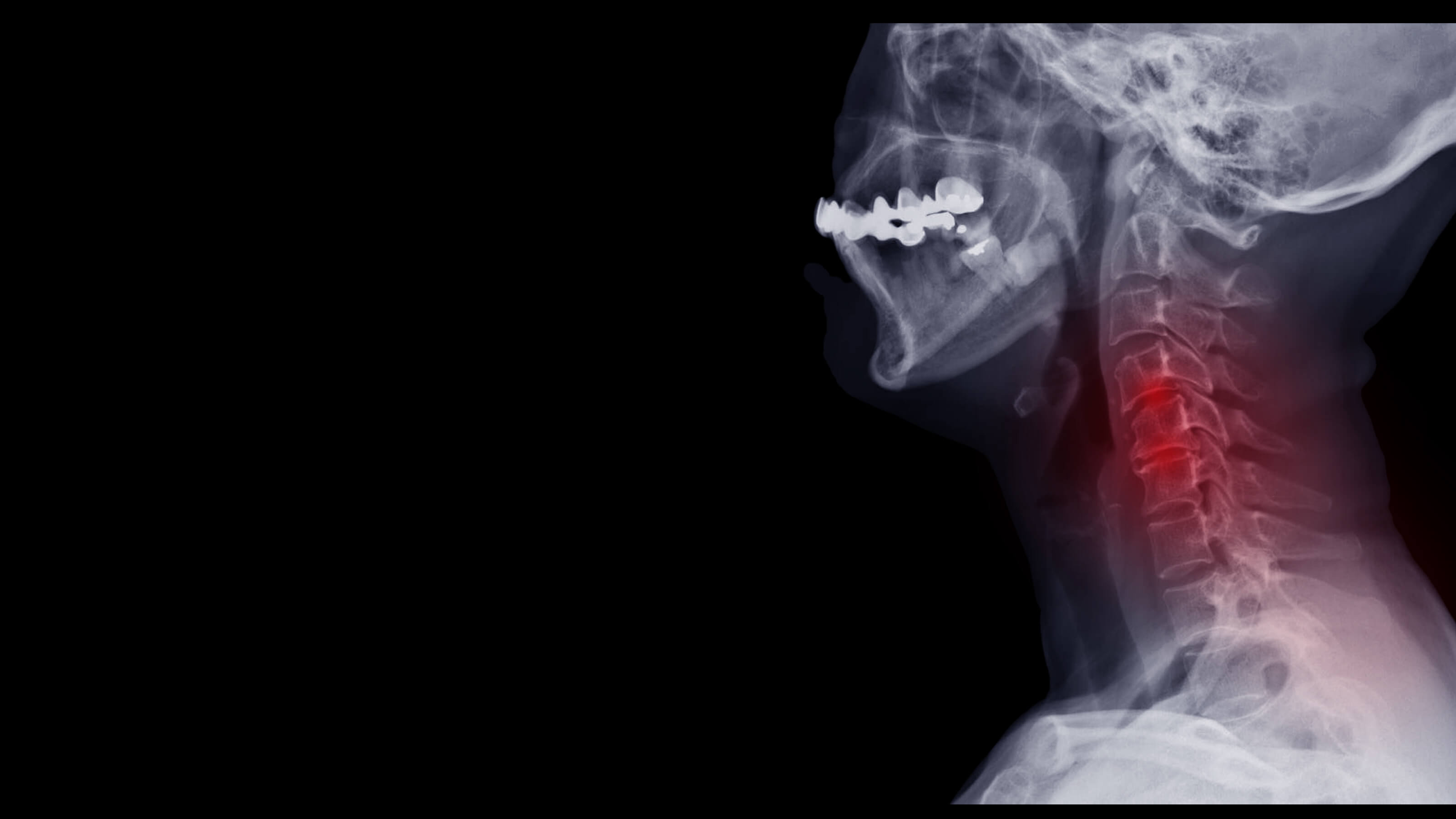 Anterior Cervical Discectomy & Fusion Surgery