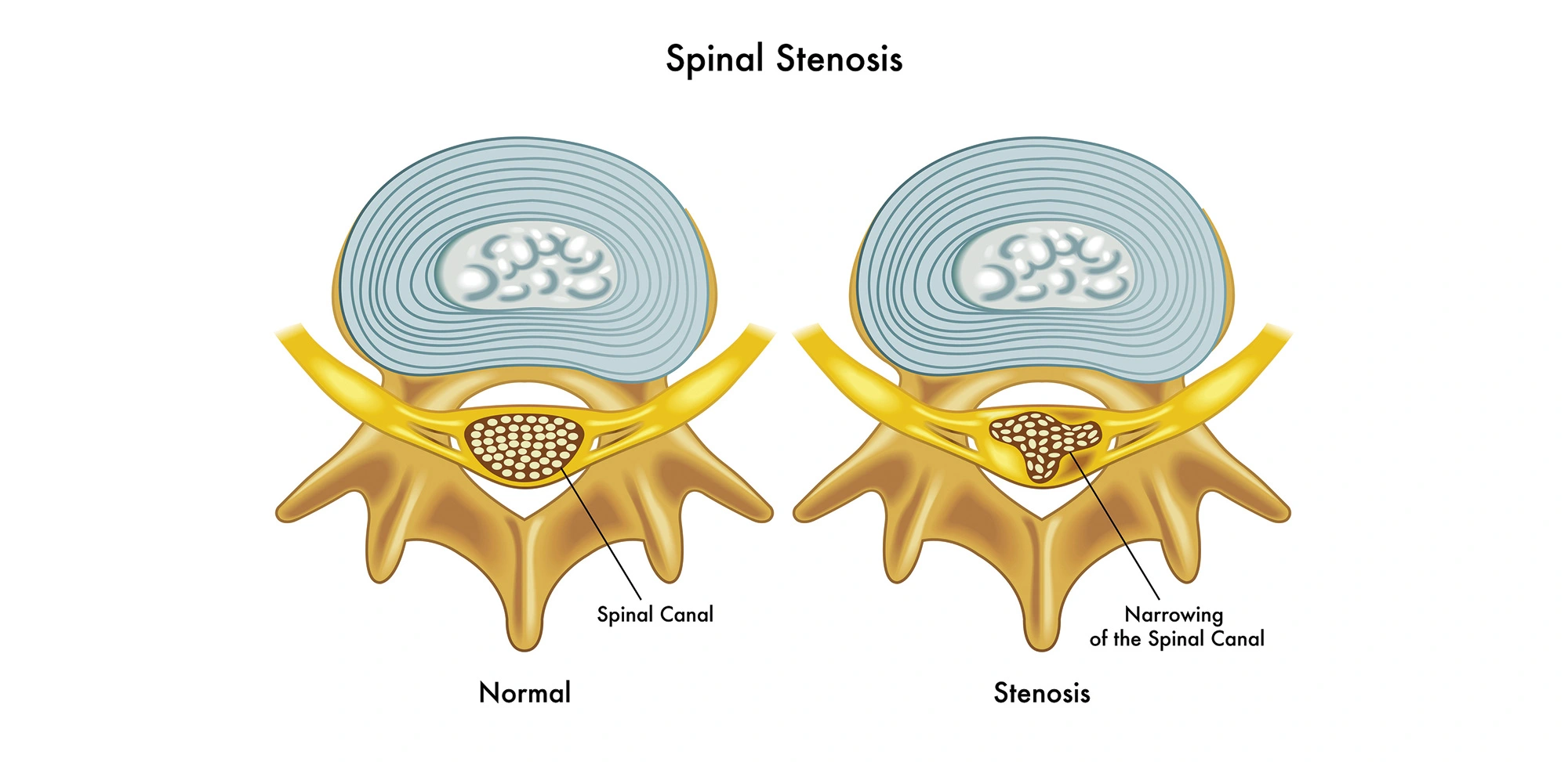 What is the Newest Treatment for Spinal Stenosis?