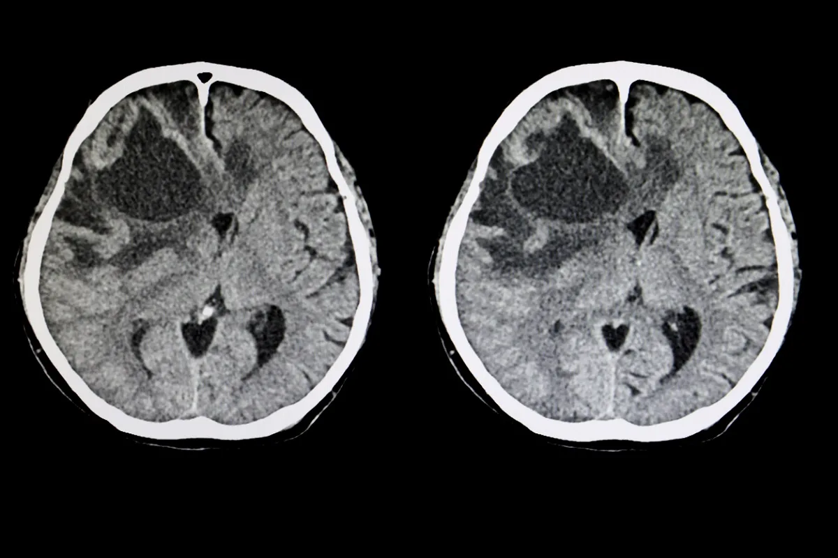 Risk Factor Analysis and Surgical Outcomes of Acute Spontaneous Spinal Subdural Hematoma. An Institutional Experience of Four Cases and Literature Review