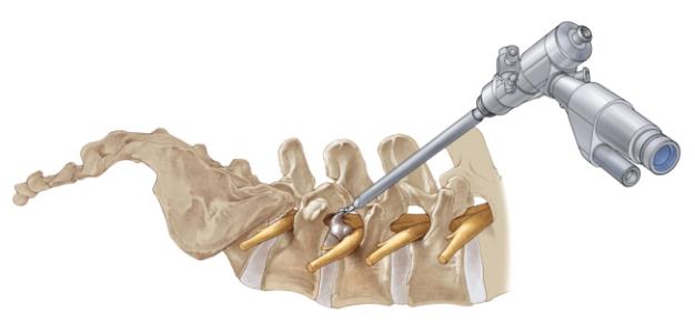 Anatomy of the Spine: How Endoscopic Techniques Target Specific Issues