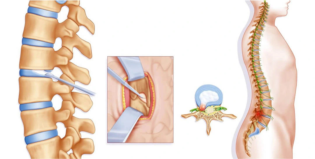 Endoscopic Lumbar Discectomy Under Local Anesthesia May Be an Alternative to Microdiscectomy: A Single Centre's Experience Using the Far Lateral Approach