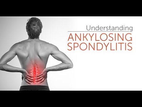 How I Cured My Ankylosing Spondylitis?
