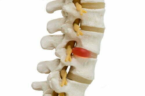 What Does a Herniated Disc Feel Like?