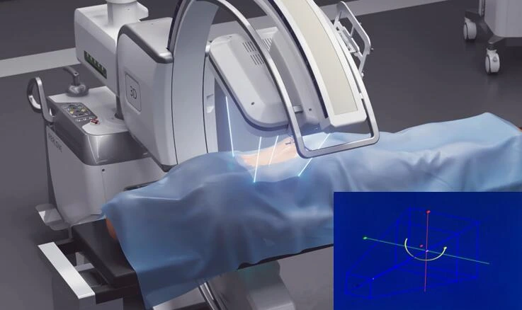 The Advantages of Robotic Spine Surgery for Complex Spinal Conditions